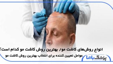 معرفی انواع روشهای کاشت مو