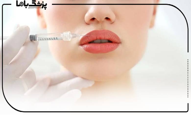 تزریق ژل لب توسط دکتر تزریق ژل غرب تهران