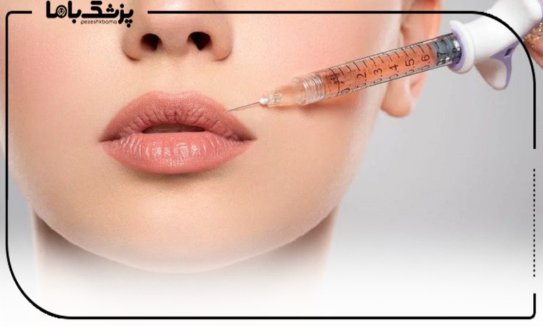 تزریق ژل توسط بهترین دکتر تزریق فیلر لب در کرج