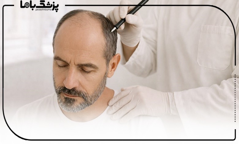 طراحی خط رویش توسط دکتر کاشت مو تبریز