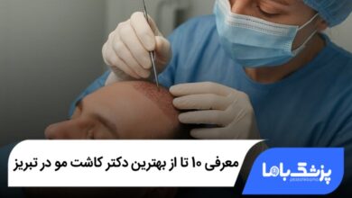 بهترین دکتر کاشت مو در تبریز