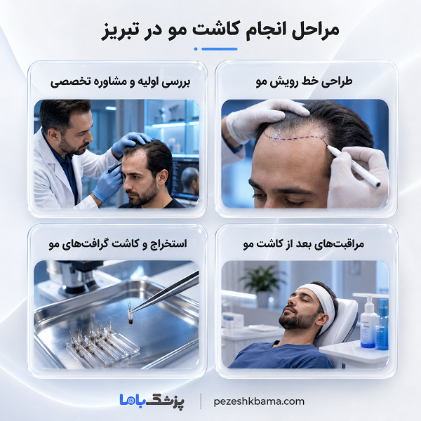 مراحل انجام کاشت مو در تبریز