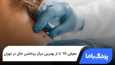 بهترین مرکز برداشتن خال در تهران