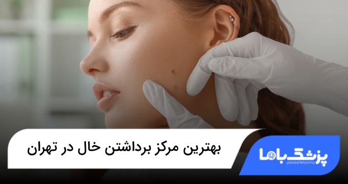 بهترین مرکز برداشتن خال در تهران