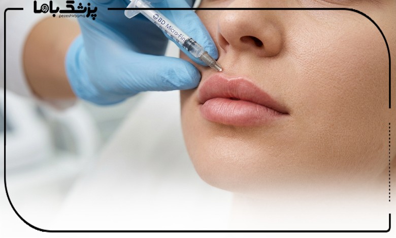 تزریق ژل لب روسی توسط بهترین دکتر تزریق ژل لب روسی در مشهد