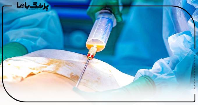 وظایف بهترین دکتر لیپوماتیک سعادت آباد