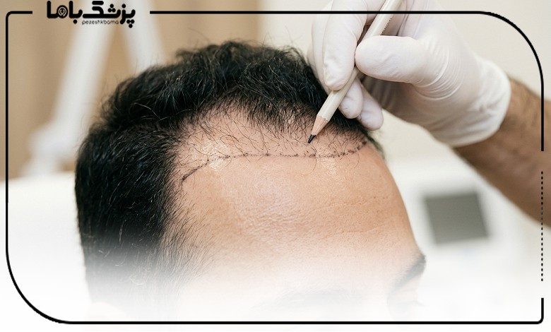 طراحی خط رویش توسط بهترین دکتر کاشت مو در تهرانپارس
