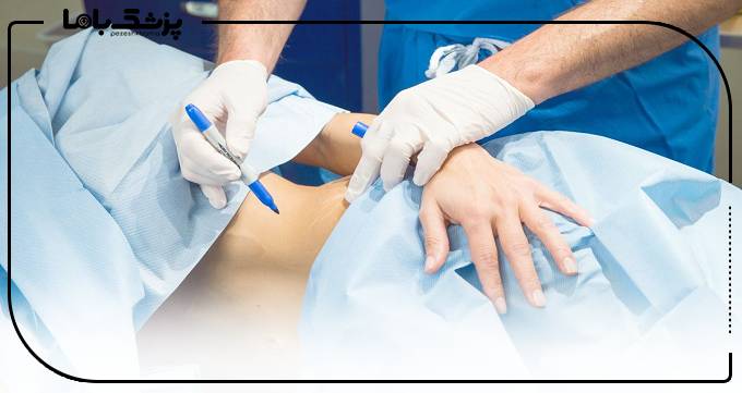 انواع تکنیکهای بهترین متخصص لیپوماتیک تهرانپارس برای جراحی