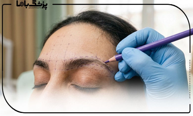 طراحی ابرو توسط بهترین دکتر کاشت ابرو در تبریز