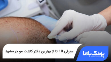بهترین دکتر کاشت مو در مشهد