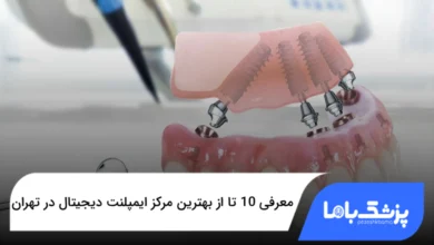 بهترین مرکز ایمپلنت دیجیتال در تهران