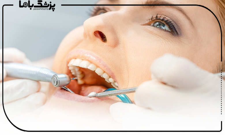 تفاوت کامپوزیت دندان با لمینت سرامیکی