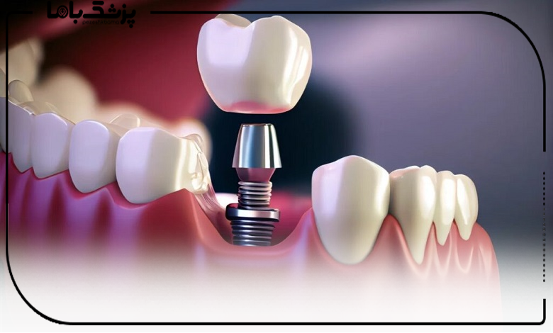 هزینه خدمات بهترین دکتر ایمپلنت دیجیتال در ایران