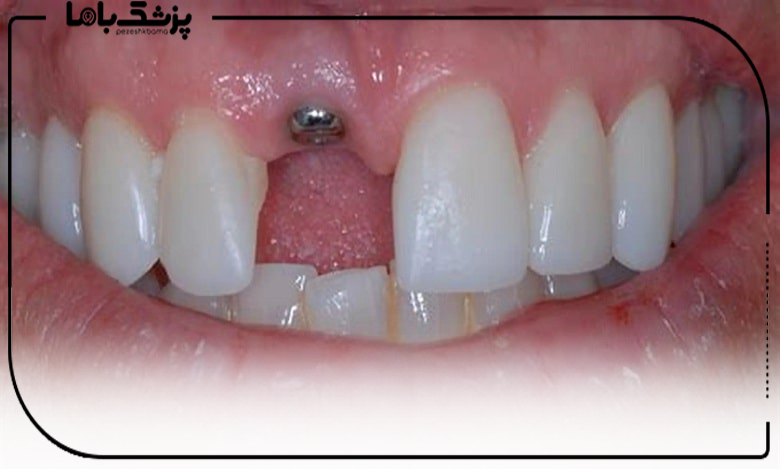 مراحل انجام ایمپلنت دیجیتالی