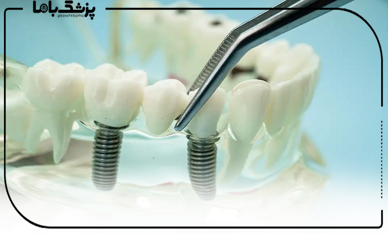 هزینه خدمات بهترین دکتر ایمپلنت فوری در ایران