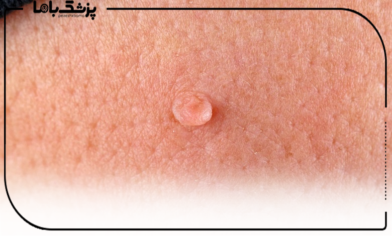 راههای اصلی انتقال زگیل تناسلی کداماند؟