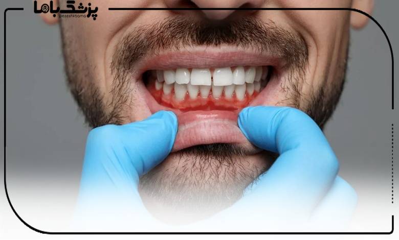 معاینه لثه توسط بهترین دکتر لثه در ایران