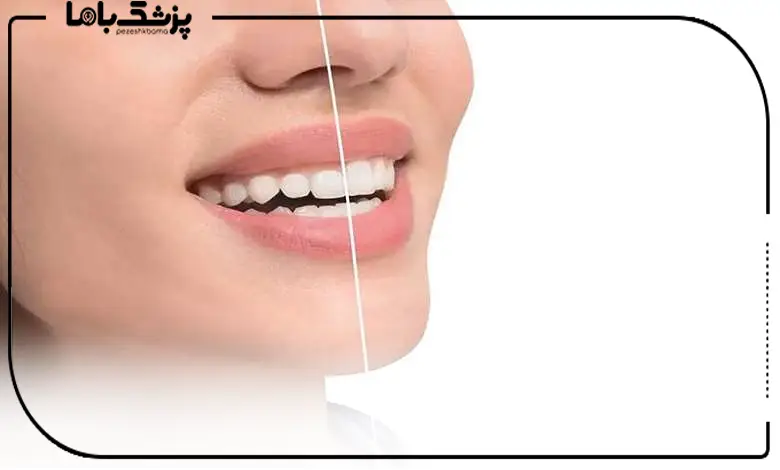 انواع روشهای لیفت لثه