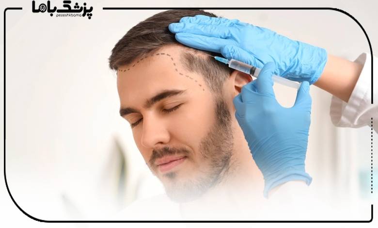 نکات کلیدی برای انتخاب دکتر کاشت مو در شیراز