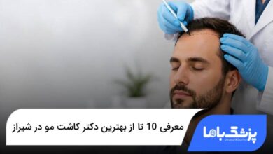 بهترین دکتر کاشت مو در شیراز