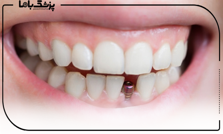 مراقبتهای بعد از ایمپلنت دندان