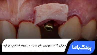 بهترین دکتر ایمپلنت با پیوند استخوان در کرج