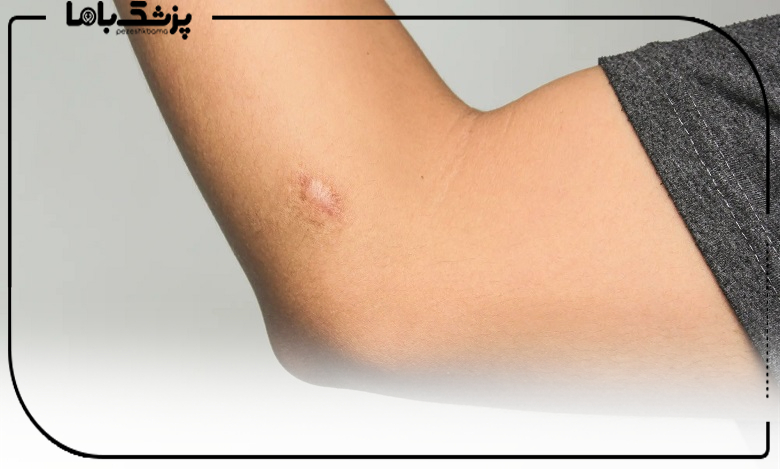 علل ایجاد کلوئید و نقش ژنتیک و محیط در آن