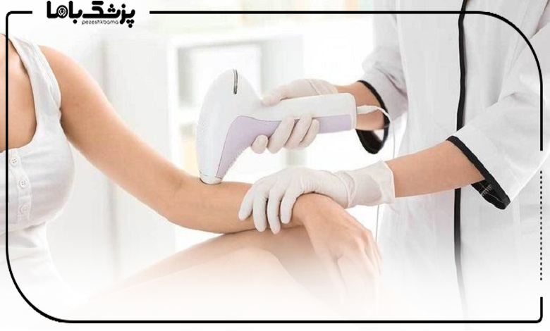 آیا لیزر برای موهای نازک و کرکی مؤثر است؟