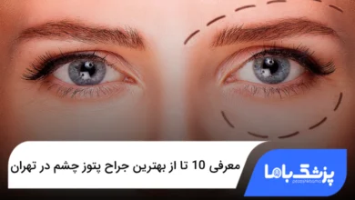 بهترین جراح پتوز چشم در تهران
