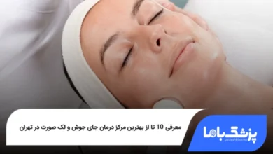 بهترین مرکز درمان جای جوش و لک صورت در تهران