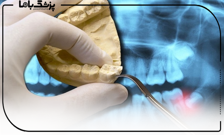 توصیه های بهترین جراح دندان عقل نهفته در شهریار