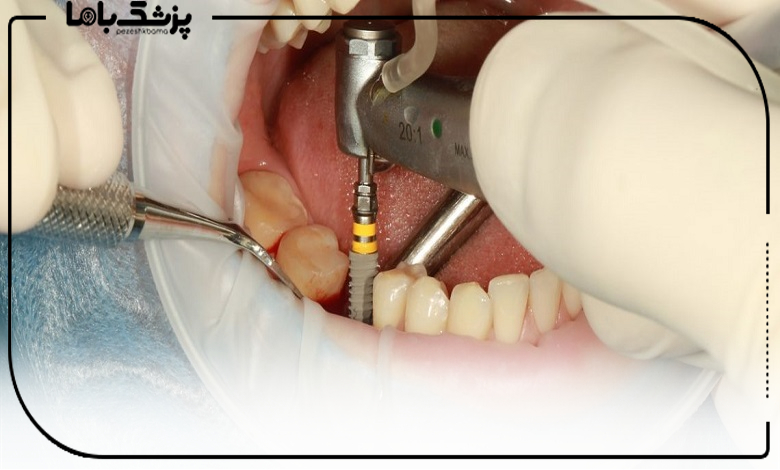 مراحل انجام ایمپلنت دندان