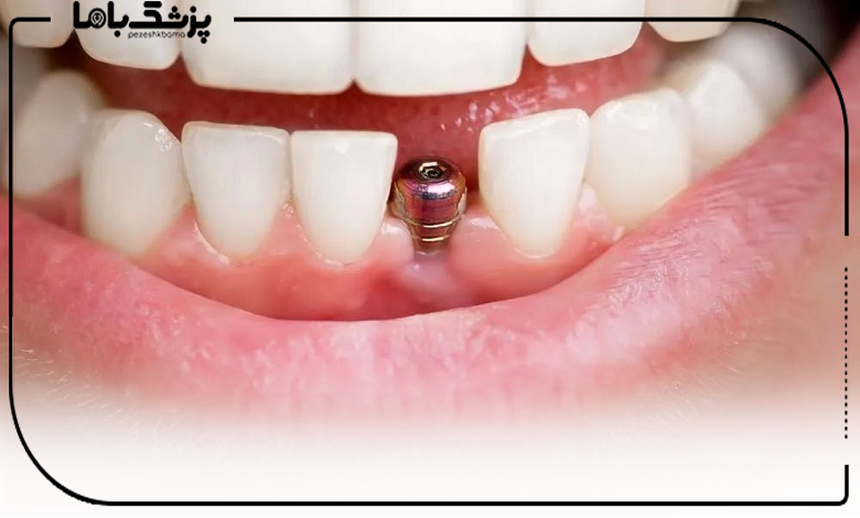 مراقبتهای بعد از کاشت ایمپلنت