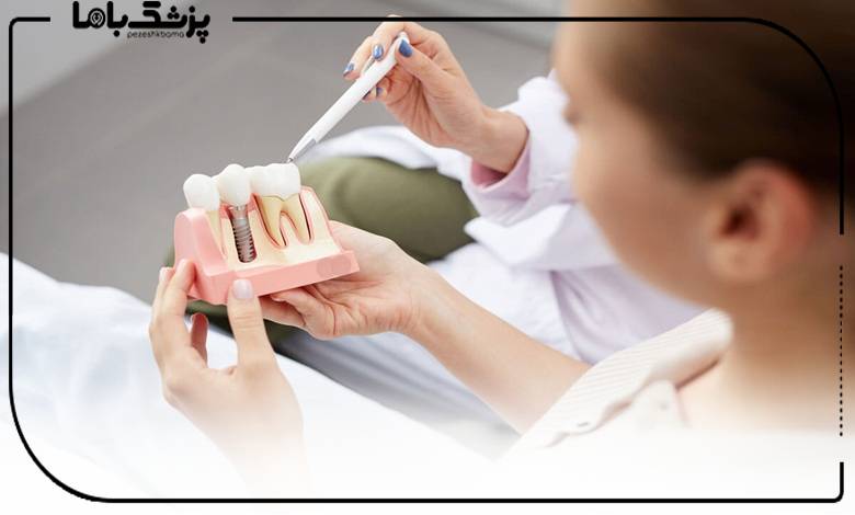 ماندگاری و طول عمر ایمپلنت دندان چقدر است؟