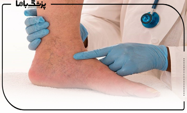 چه زمانی باید به دکتر واریس مراجعه کنیم؟