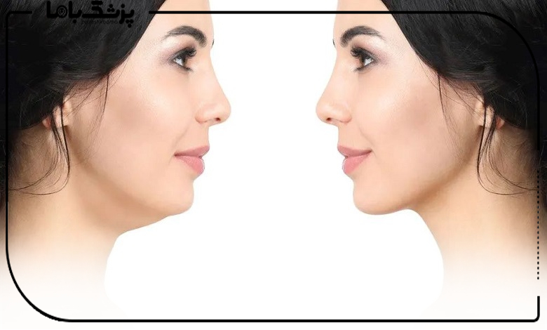 توصیه های مراقبتی قبل و بعد از ساکشن غبغب