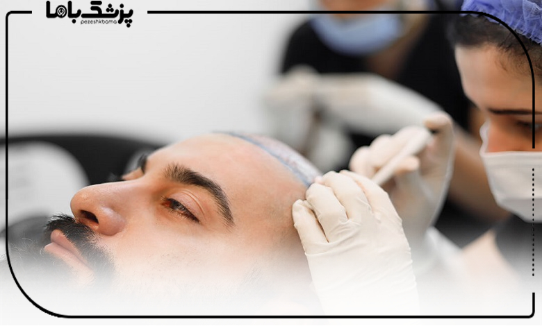 بررسی تکنیکهای رایج کاشت مو بدون جراحی