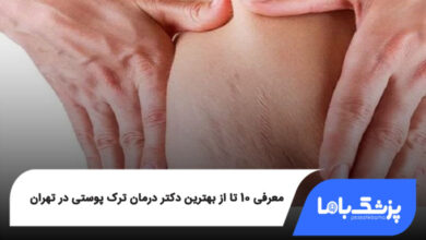 بهترین دکتر درمان ترک پوستی در تهران