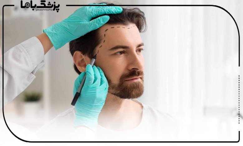 تعیین خط رویش مو توسط دکتر کاشت مو مشهد