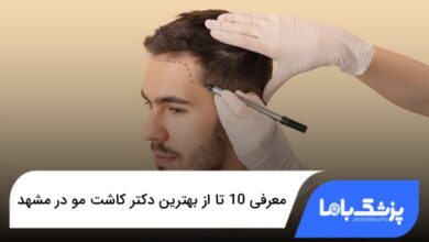 بهترین دکتر کاشت مو در مشهد