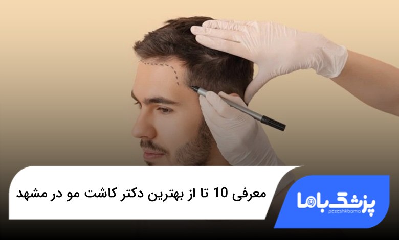 بهترین دکتر کاشت مو در مشهد
