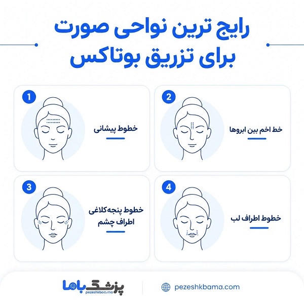 رایج ترین نواحی صورت برای تزریق بوتاکس