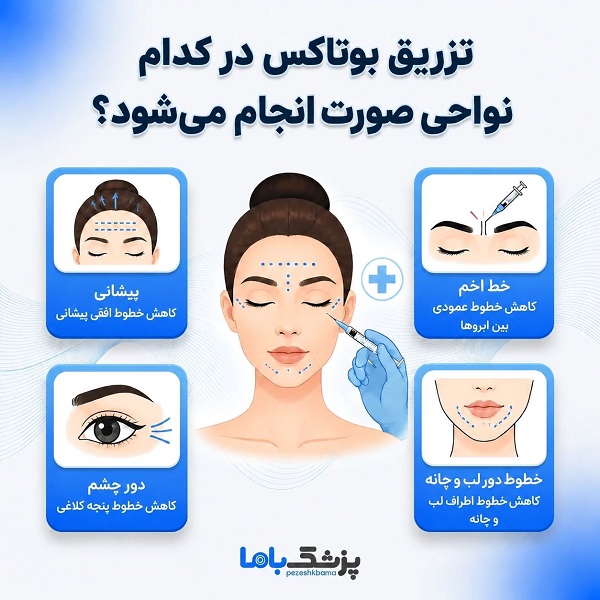 تزریق بوتاکس در کدام نواحی صورت انجام می شود؟