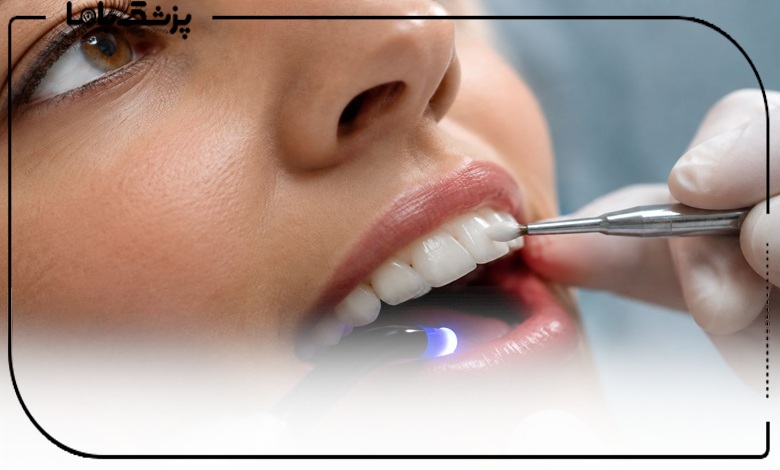 چگونه بهترین دکتر کامپوزیت دندان در تبریز را انتخاب کنیم؟