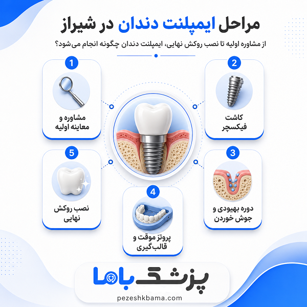 مهمترین فاکتورها در انتخاب پزشک ایمپلنت