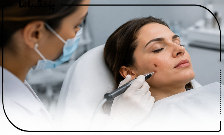 برای خال برداری به چه مرکزی مراجعه کنیم؟
