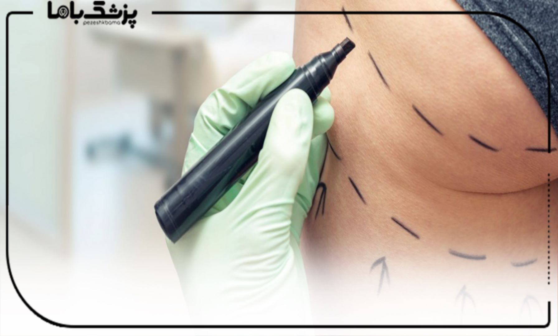 دوره نقاهت جراحی لیفت ران چقدر است؟