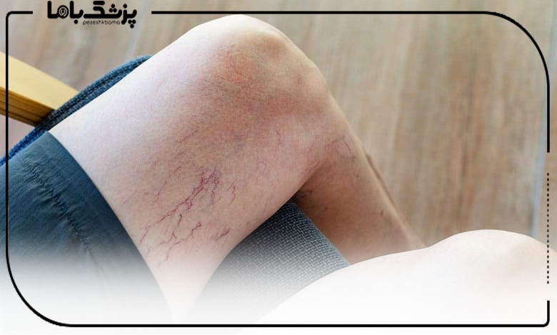 چه افرادی بیشتر در معرض واریس پا هستند؟