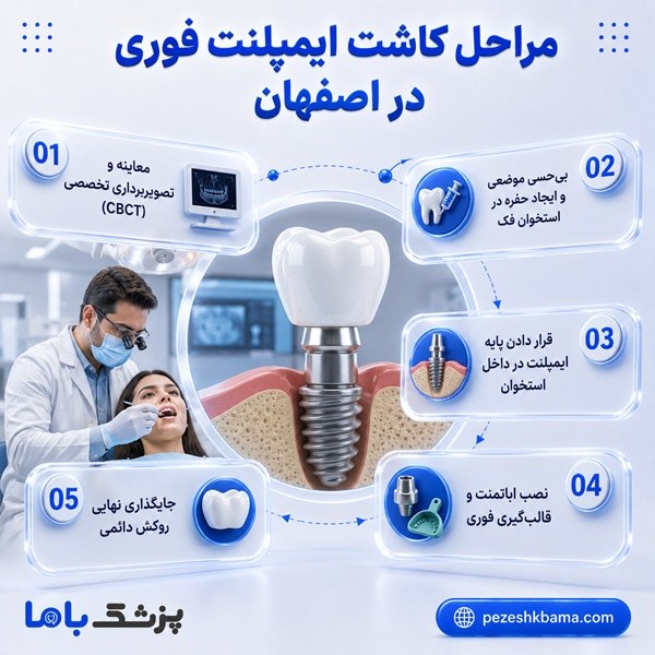 مراحل کاشت ایمپلنت فوری در اصفهان