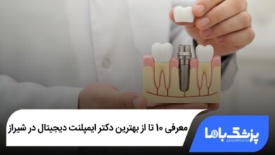 بهترین دکتر ایمپلنت دیجیتال در شیراز